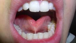 Entenda o que é a língua presa e suas implicações