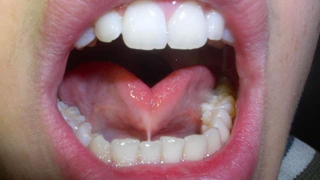 Entenda o que é a língua presa e suas implicações