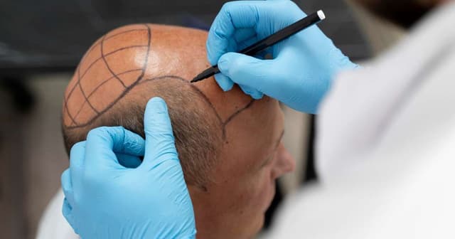 Crescimento do mercado de transplante capilar até 2032