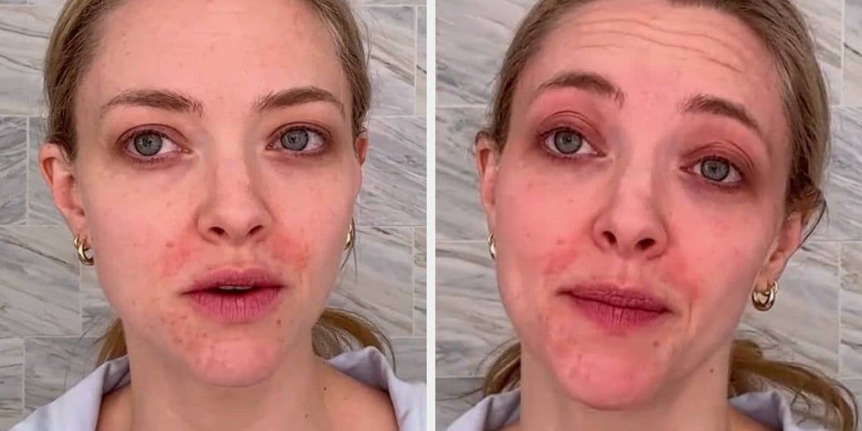 Amanda Seyfried exibe pele natural e revela eczema